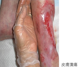 皮膚潰瘍