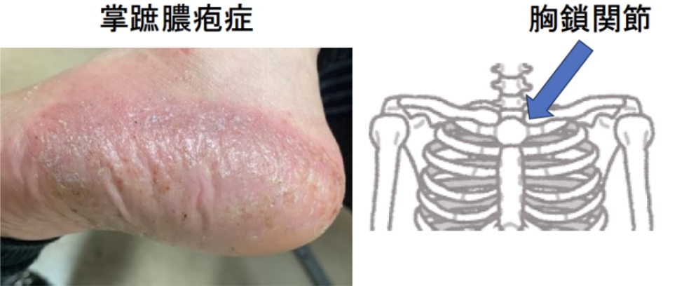 掌蹠膿疱症性骨関節炎ってなに？