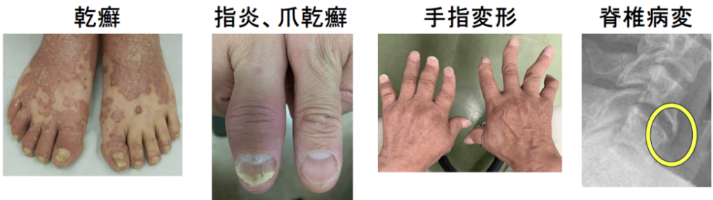 乾癬性関節炎